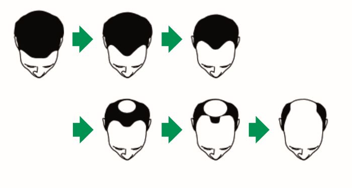 alopexy_pictogramme_druck